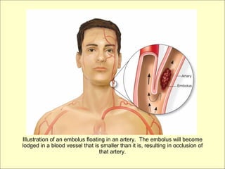 Illustration of an embolus floating in an artery. The embolus will become
lodged in a blood vessel that is smaller than it is, resulting in occlusion of
                                 that artery.
 