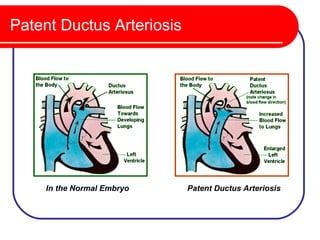 Patent Ductus Arteriosis




     In the Normal Embryo   Patent Ductus Arteriosis
 