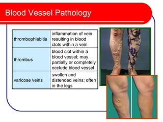 Blood Vessel Pathology

                     inflammation of vein
  thrombophlebitis   resulting in blood
                     clots within a vein
                     blood clot within a
                     blood vessel; may
  thrombus
                     partially or completely
                     occlude blood vessel
                     swollen and
  varicose veins     distended veins; often
                     in the legs
 