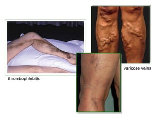varicose veins

thrombophlebitis
 
