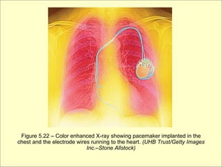 Figure 5.22 – Color enhanced X-ray showing pacemaker implanted in the
chest and the electrode wires running to the heart. (UHB Trust/Getty Images
                            Inc.–Stone Allstock)
 