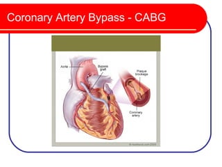 Coronary Artery Bypass - CABG
 