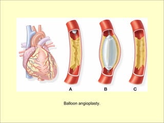 Balloon angioplasty.
 