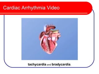 Cardiac Arrhythmia Video




          tachycardia and bradycardia.
 