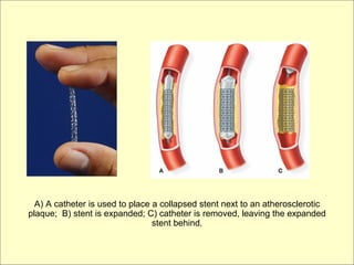 A) A catheter is used to place a collapsed stent next to an atherosclerotic
plaque; B) stent is expanded; C) catheter is removed, leaving the expanded
                                 stent behind.
 