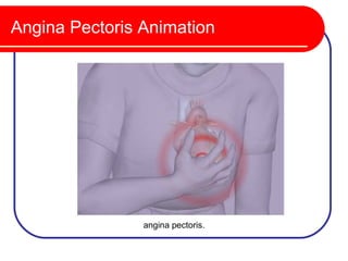 Angina Pectoris Animation




                angina pectoris.
 