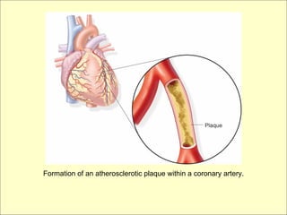 Formation of an atherosclerotic plaque within a coronary artery.
 