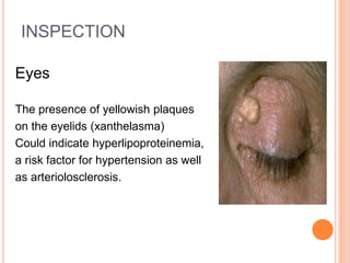 INSPECTION
Eyes
The presence of yellowish plaques
on the eyelids (xanthelasma)
Could indicate hyperlipoproteinemia,
a risk factor for hypertension as well
as arteriolosclerosis.
 