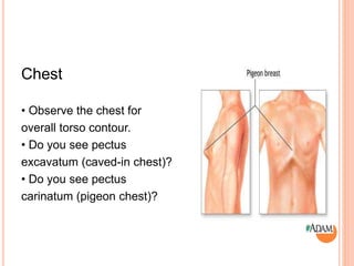 Chest
• Observe the chest for
overall torso contour.
• Do you see pectus
excavatum (caved-in chest)?
• Do you see pectus
carinatum (pigeon chest)?
 