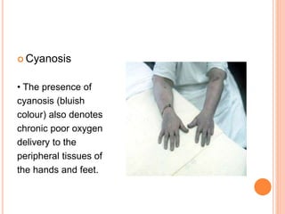  Cyanosis
• The presence of
cyanosis (bluish
colour) also denotes
chronic poor oxygen
delivery to the
peripheral tissues of
the hands and feet.
 