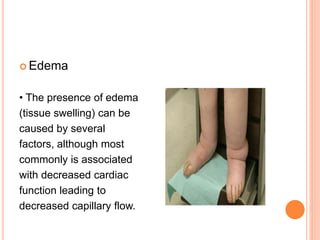  Edema
• The presence of edema
(tissue swelling) can be
caused by several
factors, although most
commonly is associated
with decreased cardiac
function leading to
decreased capillary flow.
 