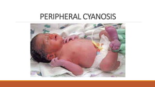 PERIPHERAL CYANOSIS
 