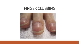 FINGER CLUBBING
 