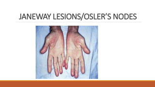 JANEWAY LESIONS/OSLER’S NODES
 