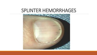 SPLINTER HEMORRHAGES
 