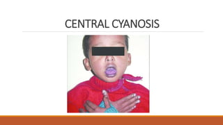 CENTRAL CYANOSIS
 