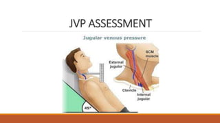 JVP ASSESSMENT
 