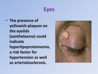 Eyes
• The presence of
yellowish plaques on
the eyelids
(xanthelasma) could
indicate
hyperlipoproteinemia,
a risk factor for
hypertension as well
as arteriolosclerosis.
 