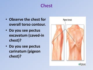 Chest
• Observe the chest for
overall torso contour.
• Do you see pectus
excavatum (caved-in
chest)?
• Do you see pectus
carinatum (pigeon
chest)?
 