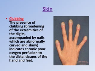 Skin
• Clubbing
The presence of
clubbing (broadening
of the extremities of
the digits,
accompanied by nails
which are abnormally
curved and shiny)
indicates chronic poor
oxygen perfusion to
the distal tissues of the
hand and feet.
 