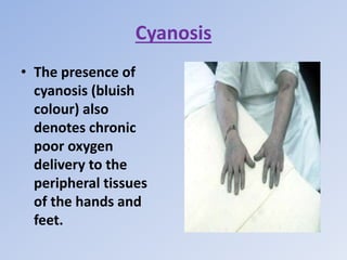 Cyanosis
• The presence of
cyanosis (bluish
colour) also
denotes chronic
poor oxygen
delivery to the
peripheral tissues
of the hands and
feet.
 