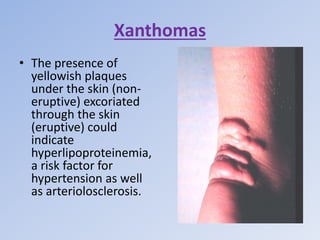 Xanthomas
• The presence of
yellowish plaques
under the skin (non-
eruptive) excoriated
through the skin
(eruptive) could
indicate
hyperlipoproteinemia,
a risk factor for
hypertension as well
as arteriolosclerosis.
 