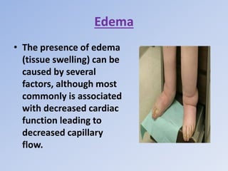 Edema
• The presence of edema
(tissue swelling) can be
caused by several
factors, although most
commonly is associated
with decreased cardiac
function leading to
decreased capillary
flow.
 