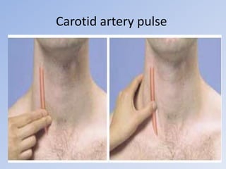 Carotid artery pulse
 