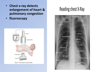 • Chest x-ray detects
enlargement of heart &
pulmonary congestion
• fluoroscopy
 