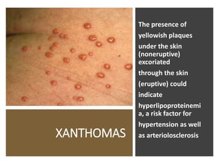 XANTHOMAS
The presence of
yellowish plaques
under the skin
(noneruptive)
excoriated
through the skin
(eruptive) could
indicate
hyperlipoproteinemi
a, a risk factor for
hypertension as well
as arteriolosclerosis
 