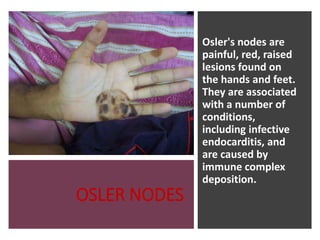 OSLER NODES
Osler's nodes are
painful, red, raised
lesions found on
the hands and feet.
They are associated
with a number of
conditions,
including infective
endocarditis, and
are caused by
immune complex
deposition.
 