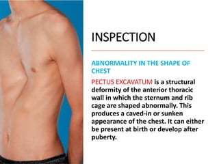 INSPECTION
ABNORMALITY IN THE SHAPE OF
CHEST
PECTUS EXCAVATUM is a structural
deformity of the anterior thoracic
wall in which the sternum and rib
cage are shaped abnormally. This
produces a caved-in or sunken
appearance of the chest. It can either
be present at birth or develop after
puberty.
 