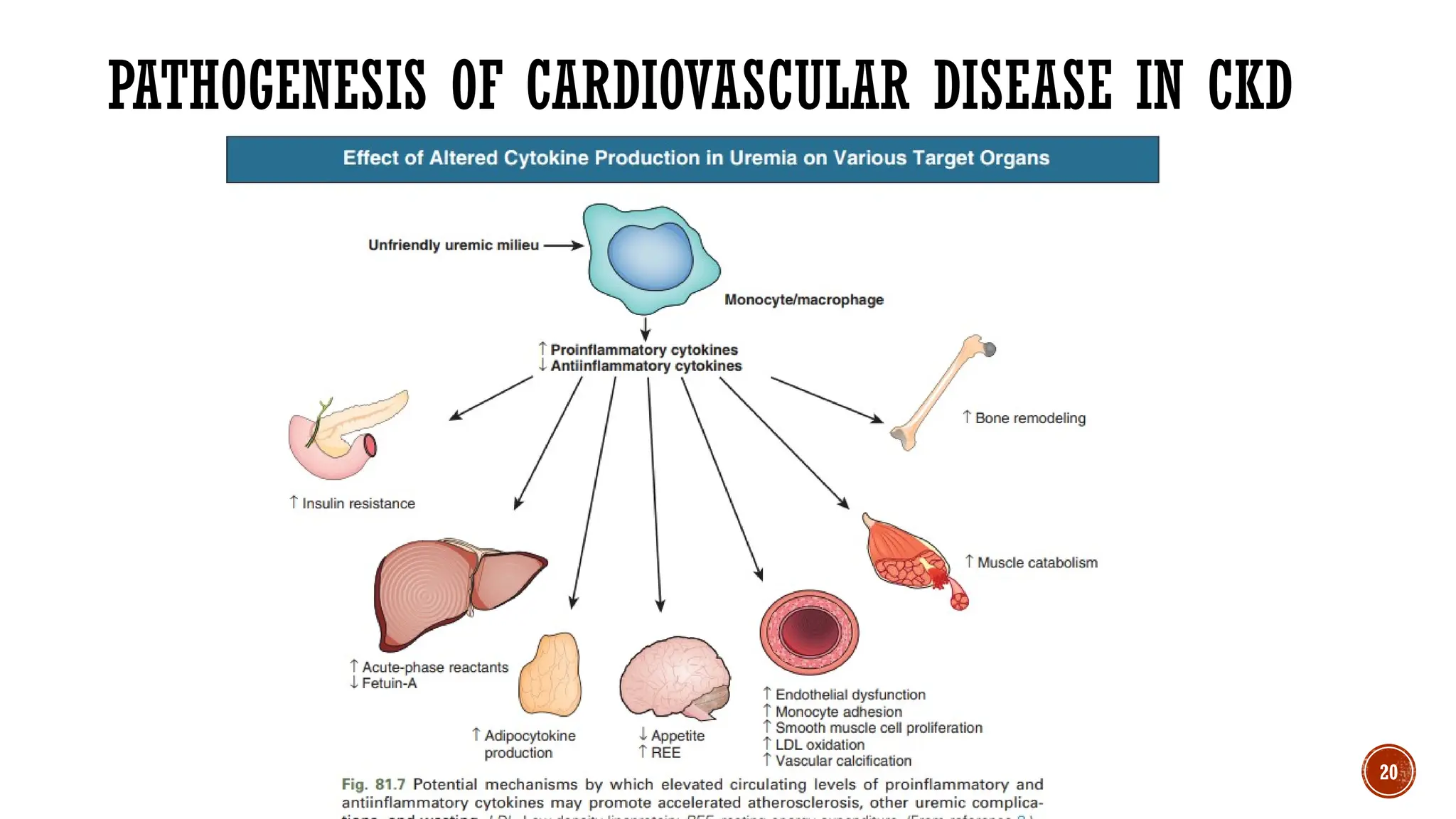 CARDIOVASCULAR COMPLICATIONS OF CHRONIC KIDNEY DISEASE.pptx