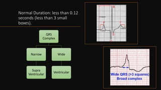Normal Duration: less than 0.12
seconds (less than 3 small
boxes).
QRS
Complex
Narrow
Supra
Ventricular
Wide
Ventricular
 