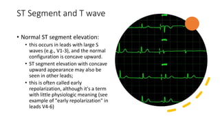 ST Segment and T wave
• Normal ST segment elevation:
• this occurs in leads with large S
waves (e.g., V1-3), and the normal
configuration is concave upward.
• ST segment elevation with concave
upward appearance may also be
seen in other leads;
• this is often called early
repolarization, although it's a term
with little physiologic meaning (see
example of "early repolarization" in
leads V4-6)
 