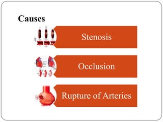 Causes
Stenosis
Occlusion
Rupture of Arteries
 