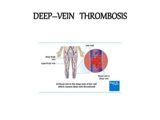 DEEP–VEIN THROMBOSIS
 