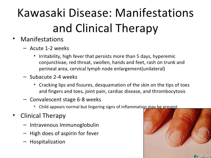 Kawasaki Disease Discharge Teaching Kawasaki Disease Discharge Teaching