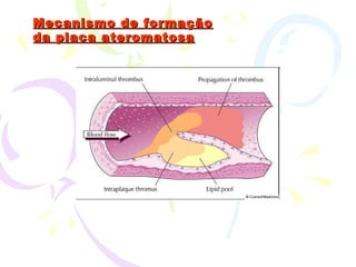Mecanismo de formação da placa ateromatosa 