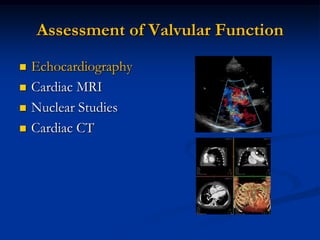 Assessment of Valvular Function
   Echocardiography
   Cardiac MRI
   Nuclear Studies
   Cardiac CT
 