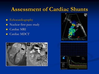 Assessment of Cardiac Shunts
   Echocardiography
   Nuclear first pass study
   Cardiac MRI
   Cardiac MDCT
 