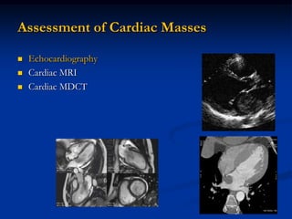 Assessment of Cardiac Masses

   Echocardiography
   Cardiac MRI
   Cardiac MDCT
 