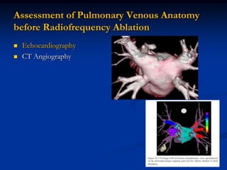 Assessment of Pulmonary Venous Anatomy
before Radiofrequency Ablation
   Echocardiography
   CT Angiography
 