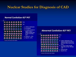 Nuclear Studies for Diagnosis of CAD
 