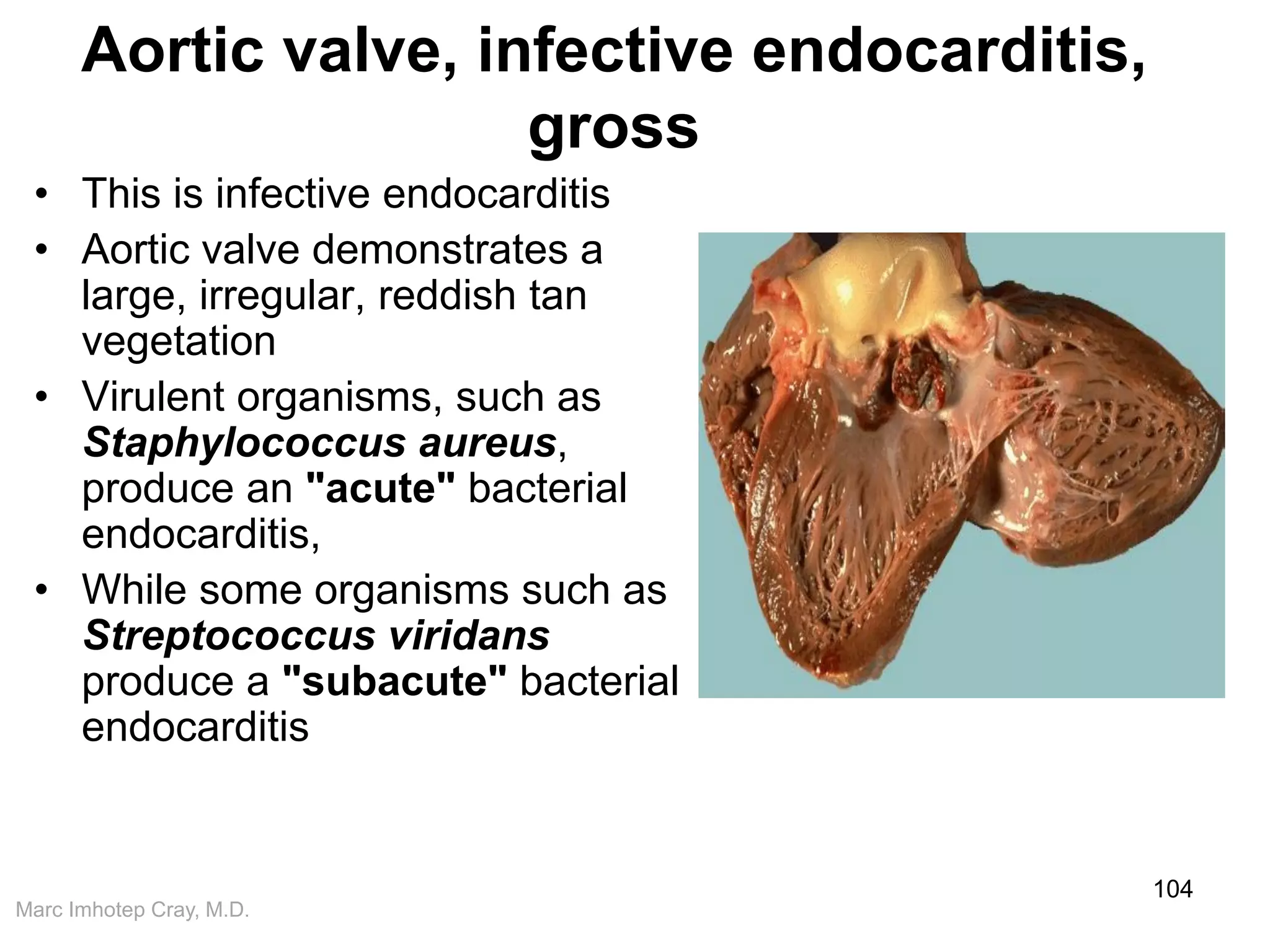 Marc Imhotep Cray, M.D.
Aortic valve, infective endocarditis,
gross
• This is infective endocarditis
• Aortic valve demonstrates a
large, irregular, reddish tan
vegetation
• Virulent organisms, such as
Staphylococcus aureus,
produce an "acute" bacterial
endocarditis,
• While some organisms such as
Streptococcus viridans
produce a "subacute" bacterial
endocarditis
104
 