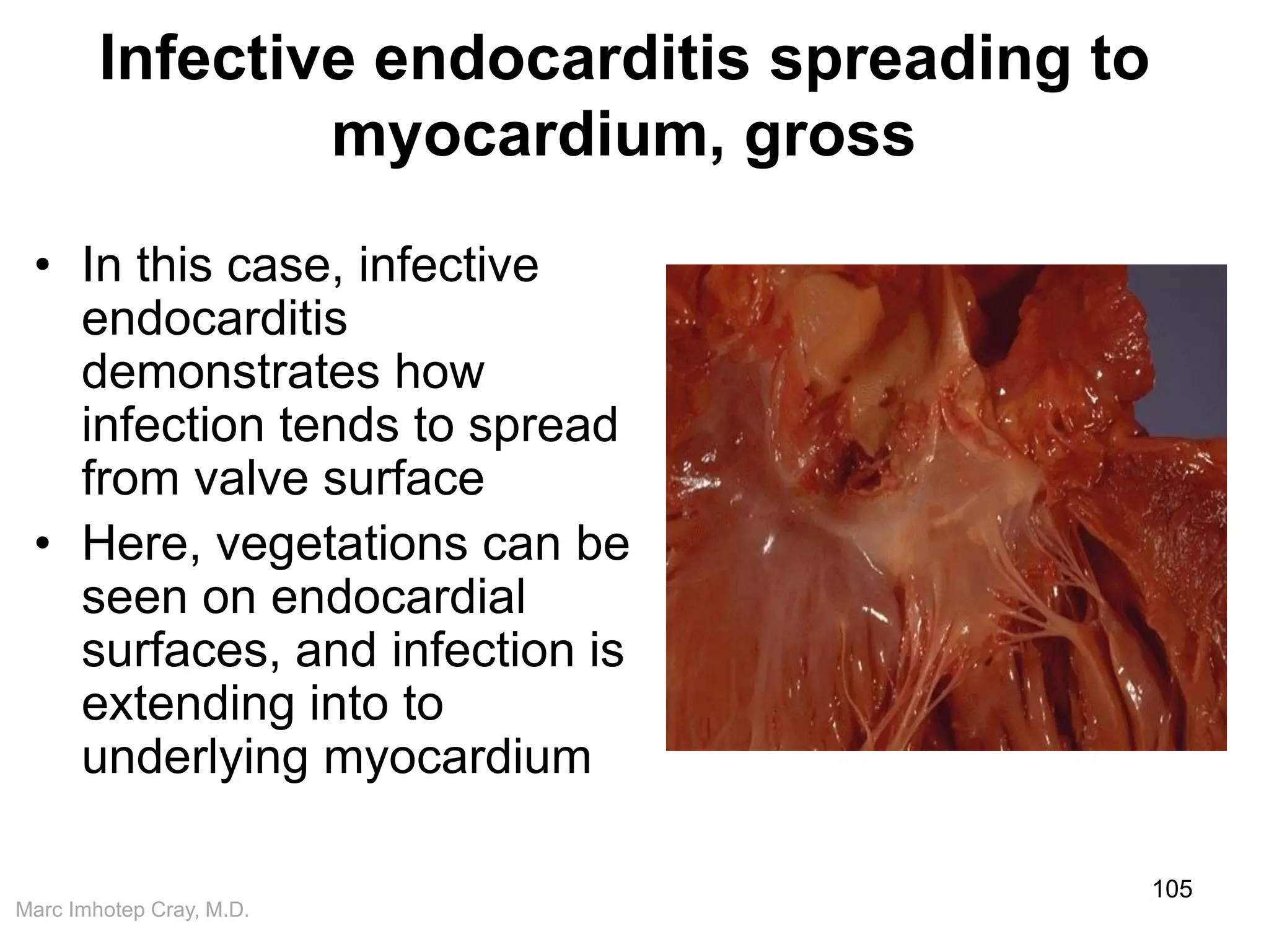 Marc Imhotep Cray, M.D.
Infective endocarditis spreading to
myocardium, gross
• In this case, infective
endocarditis
demonstrates how
infection tends to spread
from valve surface
• Here, vegetations can be
seen on endocardial
surfaces, and infection is
extending into to
underlying myocardium
105
 