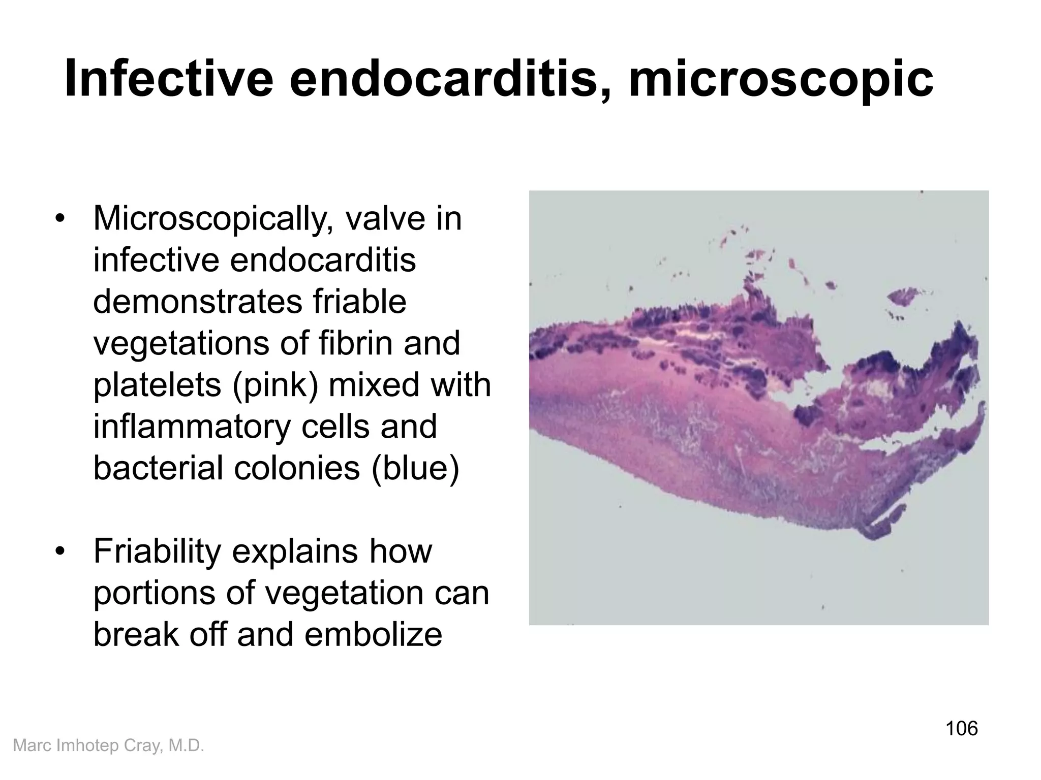 Marc Imhotep Cray, M.D.
Infective endocarditis, microscopic
106
• Microscopically, valve in
infective endocarditis
demonstrates friable
vegetations of fibrin and
platelets (pink) mixed with
inflammatory cells and
bacterial colonies (blue)
• Friability explains how
portions of vegetation can
break off and embolize
 