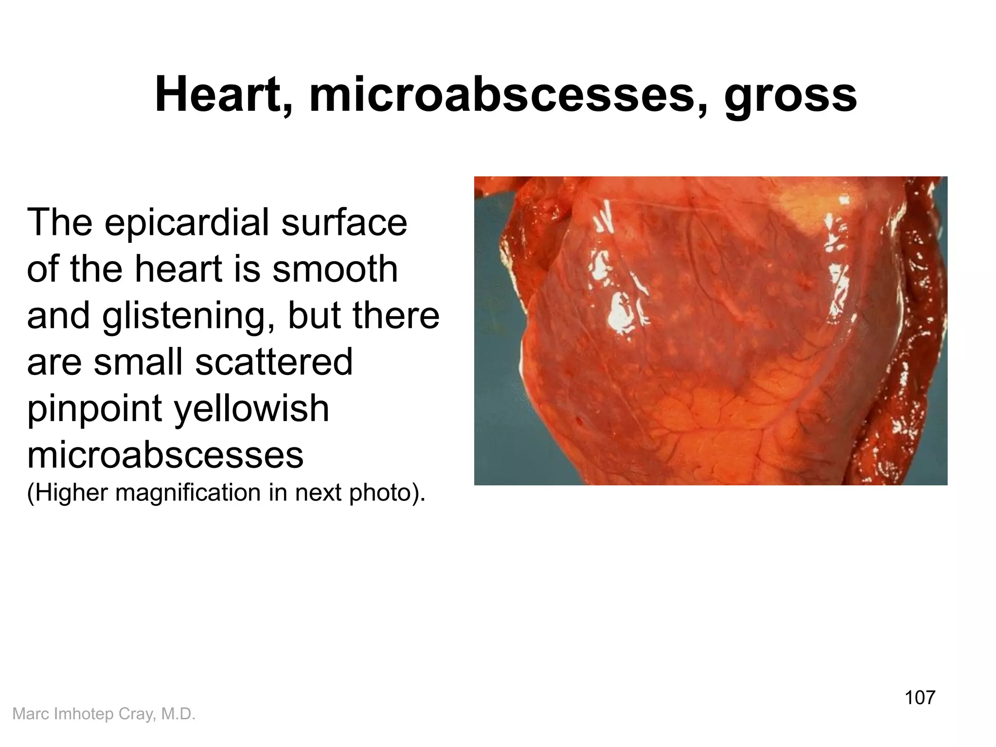 Marc Imhotep Cray, M.D.
Heart, microabscesses, gross
107
The epicardial surface
of the heart is smooth
and glistening, but there
are small scattered
pinpoint yellowish
microabscesses
(Higher magnification in next photo).
 