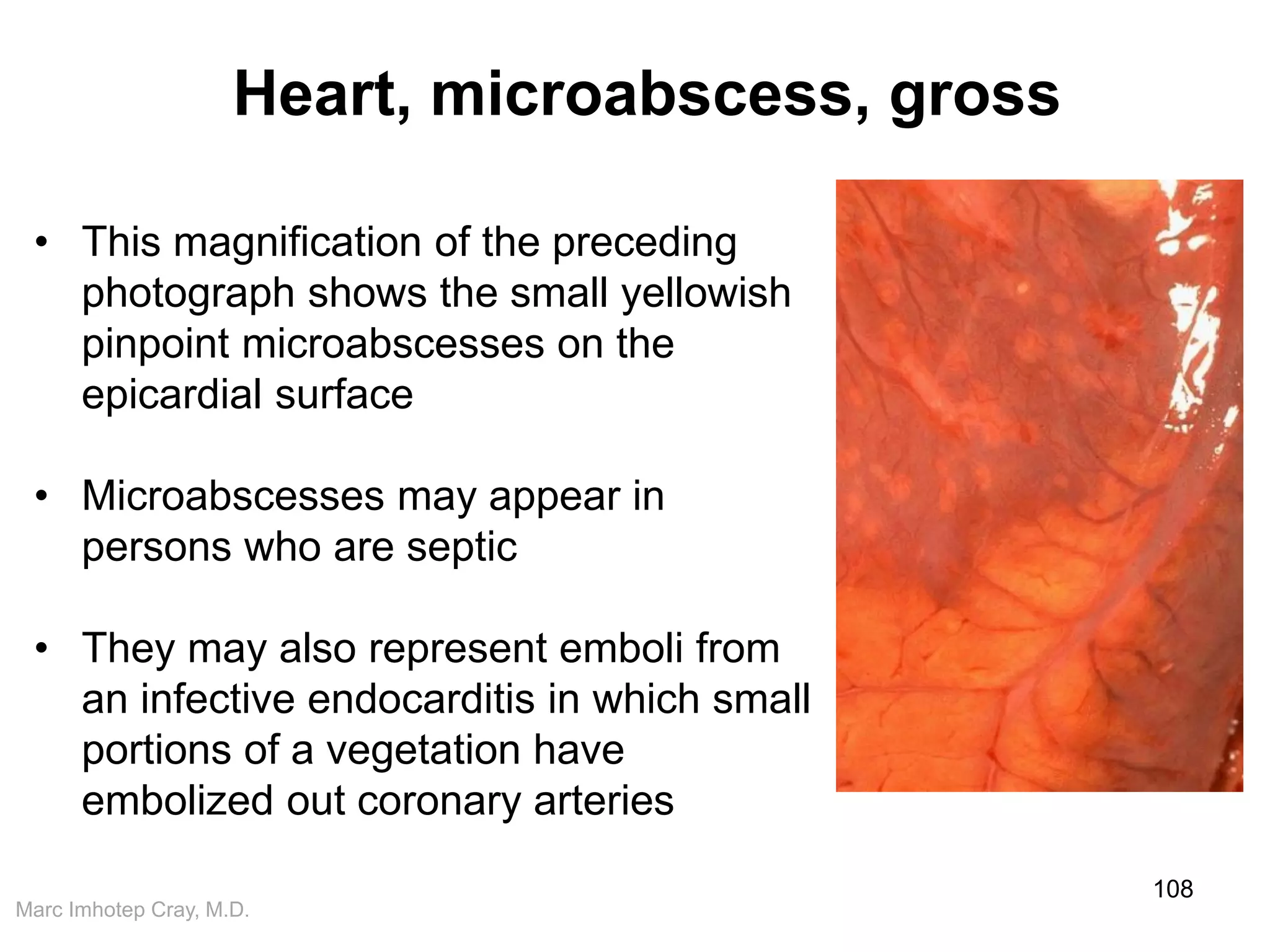Marc Imhotep Cray, M.D.
Heart, microabscess, gross
108
• This magnification of the preceding
photograph shows the small yellowish
pinpoint microabscesses on the
epicardial surface
• Microabscesses may appear in
persons who are septic
• They may also represent emboli from
an infective endocarditis in which small
portions of a vegetation have
embolized out coronary arteries
 