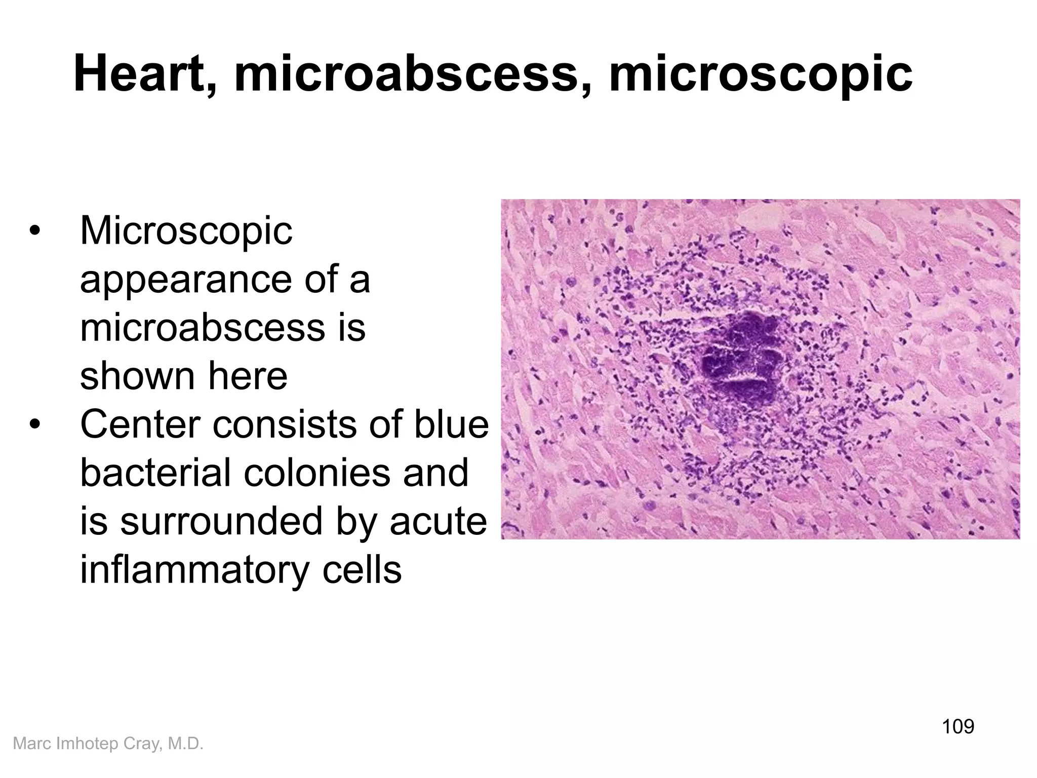 Marc Imhotep Cray, M.D.
Heart, microabscess, microscopic
109
• Microscopic
appearance of a
microabscess is
shown here
• Center consists of blue
bacterial colonies and
is surrounded by acute
inflammatory cells
 